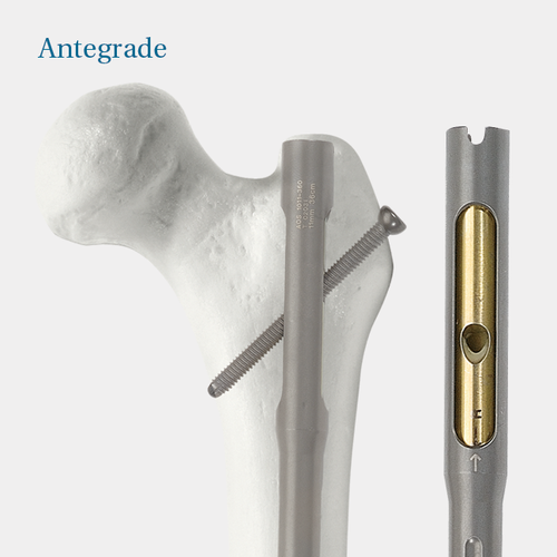 Internal Fixation: Rods and Nails | International Center for Limb  Lengthening