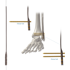 fibular-nail-system-1575455396.png